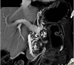 Chronic Pancreatitis - CTisus CT Scan