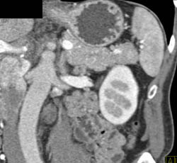 Splenic Tissue Simulates An Islet Cell Tumor - CTisus CT Scan