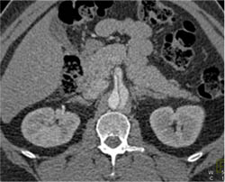 Dissection Extends Into SMA - CTisus CT Scan