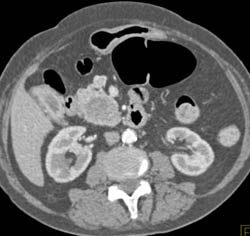 Pancreatic Cancer - CTisus CT Scan