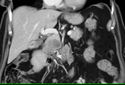 Pancreatic Cancer - CTisus CT Scan