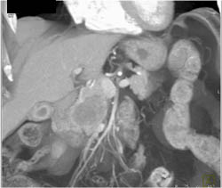 Pancreatic Cancer - CTisus CT Scan