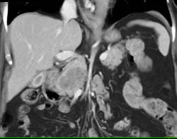 Pancreatic Cancer - CTisus CT Scan