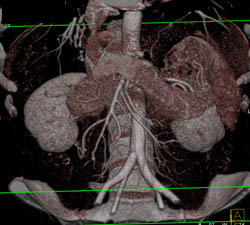 CTA of Pancreas - CTisus CT Scan