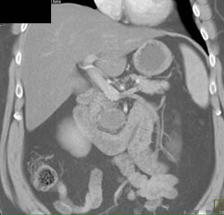 Intraductal Papillary Mucinous Neoplasms (IPMNs) - CTisus CT Scan