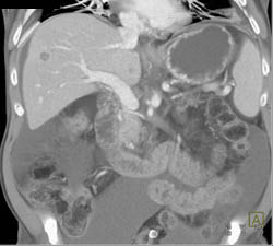 Liver Metastases From Pancreatic Cancer With Thad Defects - CTisus CT Scan