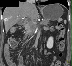 Pancreatic Cancer - CTisus CT Scan