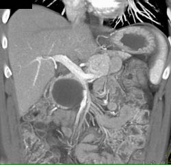 Serous Cystadenoma - CTisus CT Scan