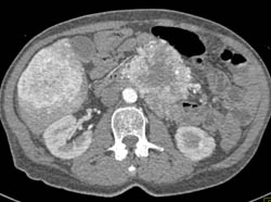 Islet Cell Tumor With Liver Metastases - CTisus CT Scan