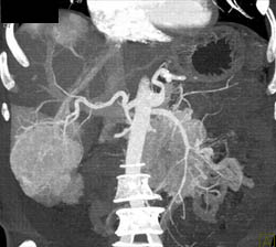 Islet Cell Tumor With Liver Metastases - CTisus CT Scan