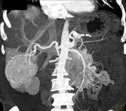 Islet Cell Tumor With Liver Metastases - CTisus CT Scan