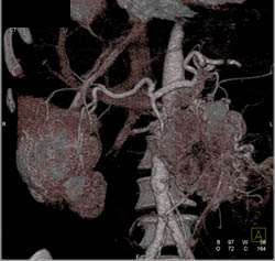 Islet Cell Tumor With Liver Metastases - CTisus CT Scan