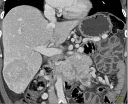 Islet Cell Tumor With Liver Metastases - CTisus CT Scan