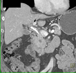 Pancreatic Cancer - CTisus CT Scan