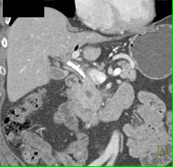 Pancreatic Cancer - CTisus CT Scan