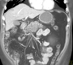 Pancreatic Cancer - CTisus CT Scan