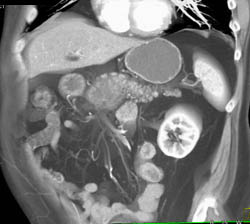 Pancreatic Cancer - CTisus CT Scan