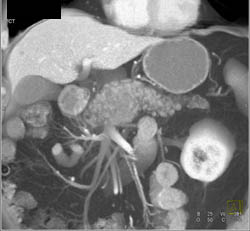 Pancreatic Cancer - CTisus CT Scan