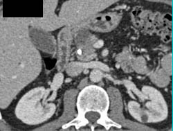 Pancreatic Carcinoma - CTisus CT Scan