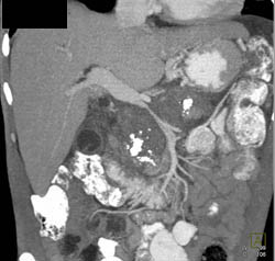 Pancreatic Cancer Arises in Chronic Pancreatitis With Superior Mesenteric Vein (SMV) Encased - CTisus CT Scan