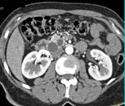 Ampullary Mass - CTisus CT Scan