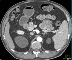 Cystadenoma of the Pancreas - CTisus CT Scan