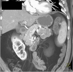 Cystadenoma of the Pancreas - CTisus CT Scan