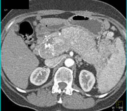 Islet Cell Tumor Occludes the Splenic Vein An Portal Vein - CTisus CT Scan