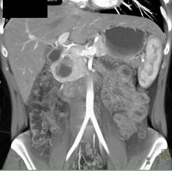 Hamoudi Tumor Or SPEN - CTisus CT Scan