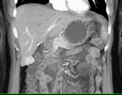 Intraductal Papillary Mucinous Neoplasm (IPMN) - CTisus CT Scan