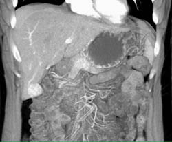 Intraductal Papillary Mucinous Neoplasm (IPMN) - CTisus CT Scan