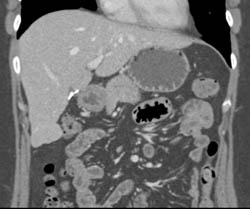 Focal Nodular Hyperplasia (FNH) Right Lobe of Liver on Multiple Phases - CTisus CT Scan