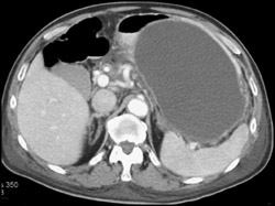 Pseudocyst in Lesser Sac - CTisus CT Scan