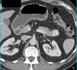 Islet Cell Tail of Pancreas - CTisus CT Scan