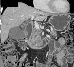 Ampullary Mass C/w Adenocarcinoma - CTisus CT Scan