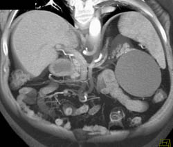 Mesenteric Cyst - CTisus CT Scan