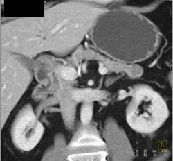 Intraductal Papillary Mucinous Neoplasm (IPMN) - CTisus CT Scan