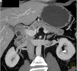 Intraductal Papillary Mucinous Neoplasm (IPMN) - CTisus CT Scan