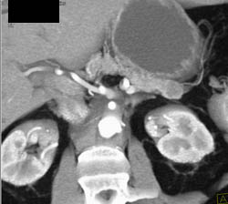 Intraductal Papillary Mucinous Neoplasm (IPMN) - CTisus CT Scan