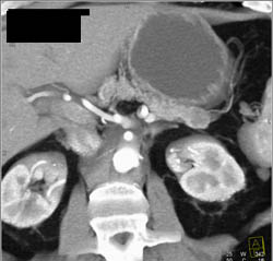 Intraductal Papillary Mucinous Neoplasm (IPMN) - CTisus CT Scan