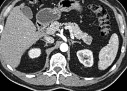 Intraductal Papillary Mucinous Neoplasm (IPMN) - CTisus CT Scan