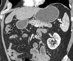 Intraductal Papillary Mucinous Neoplasm (IPMN) - CTisus CT Scan