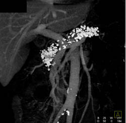 Chronic Pancreatitis - CTisus CT Scan