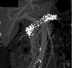 Chronic Pancreatitis - CTisus CT Scan