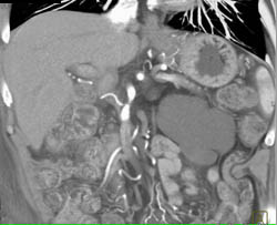 Lymphangioma - CTisus CT Scan