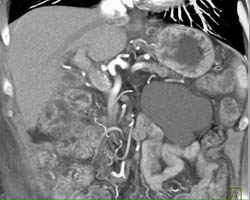 Lymphangioma - CTisus CT Scan