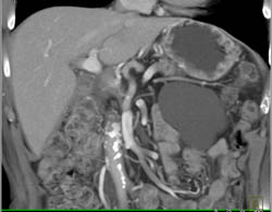 Lymphangioma - CTisus CT Scan