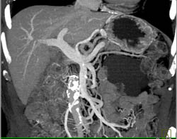 Lymphangioma - CTisus CT Scan