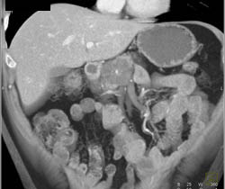 Cystadenoma - CTisus CT Scan