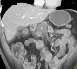 Cystadenoma - CTisus CT Scan